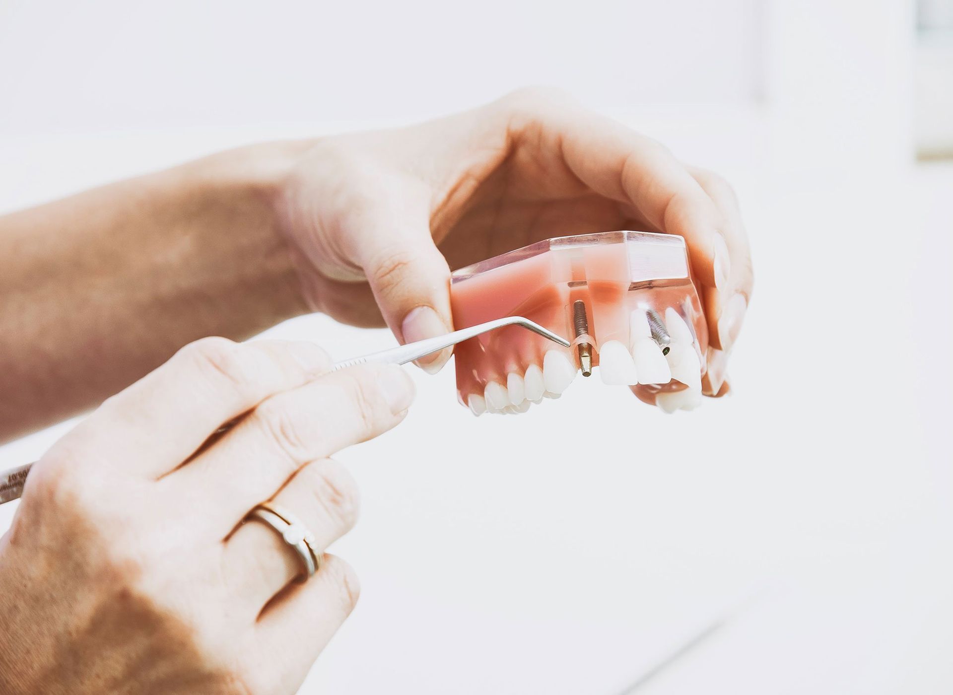 Dental Implants in Apopka, FL A person is holding a model of a dental implant in their hands.