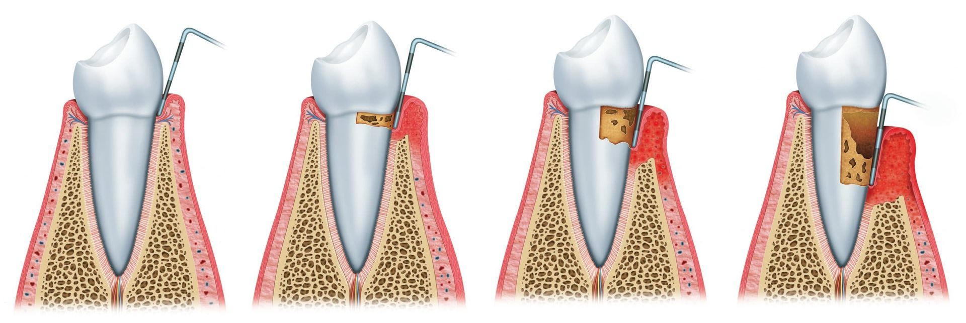 Gum Disease A diagram showing the stages of tooth decay