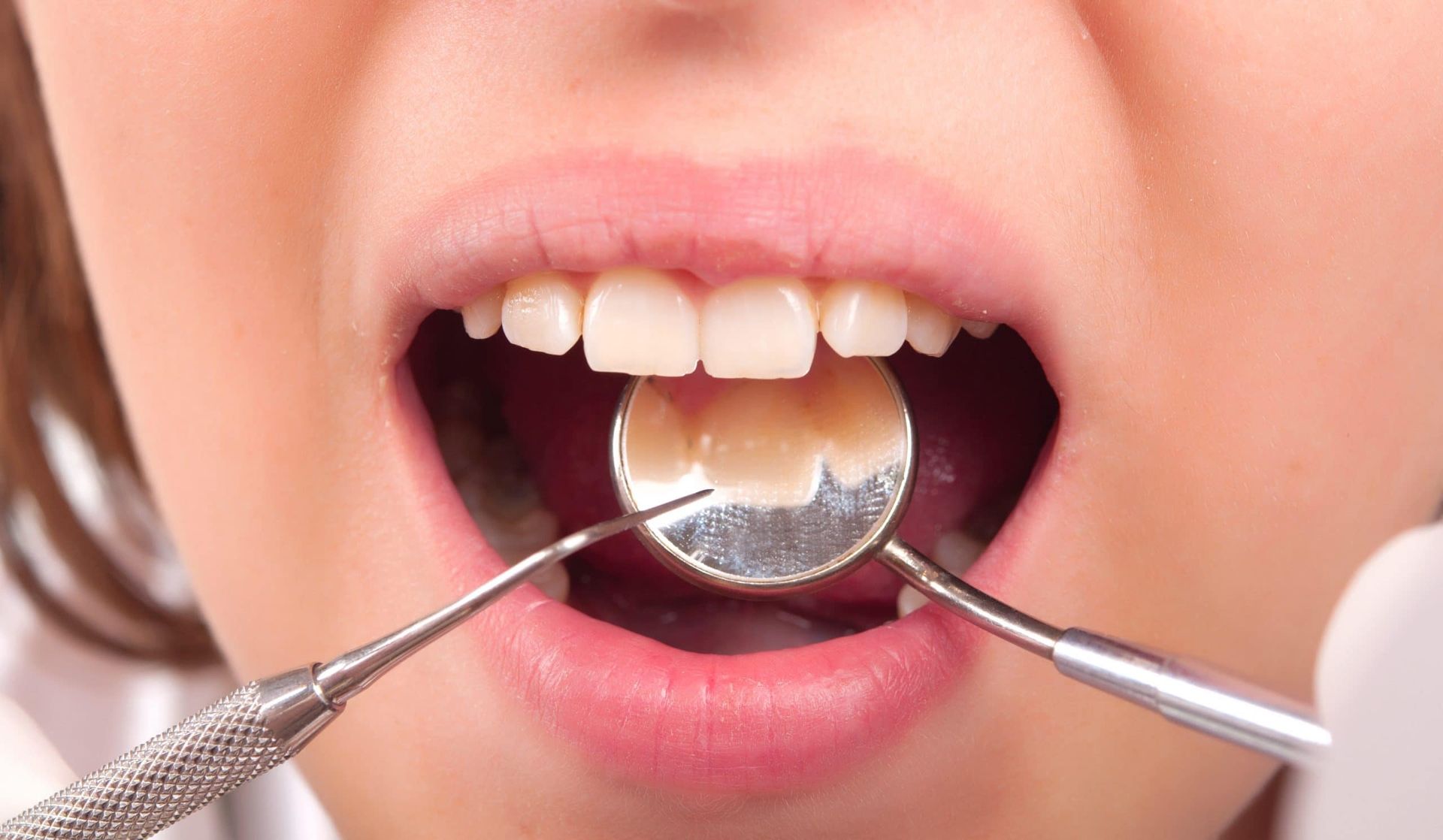 cosmetic treatments in Apopka A woman is getting her teeth examined by a dentist.