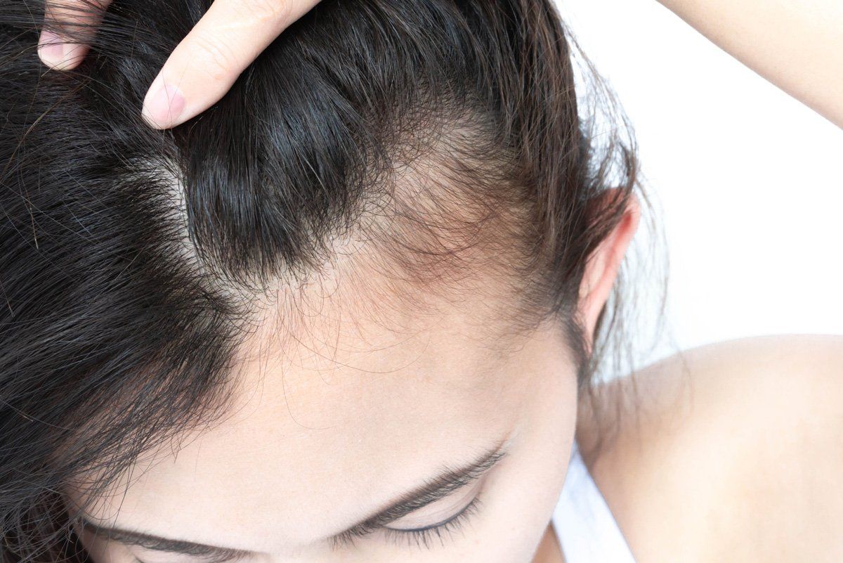 Woman Serious Hair Loss Problem — Minneapolis, MN — Apollo International