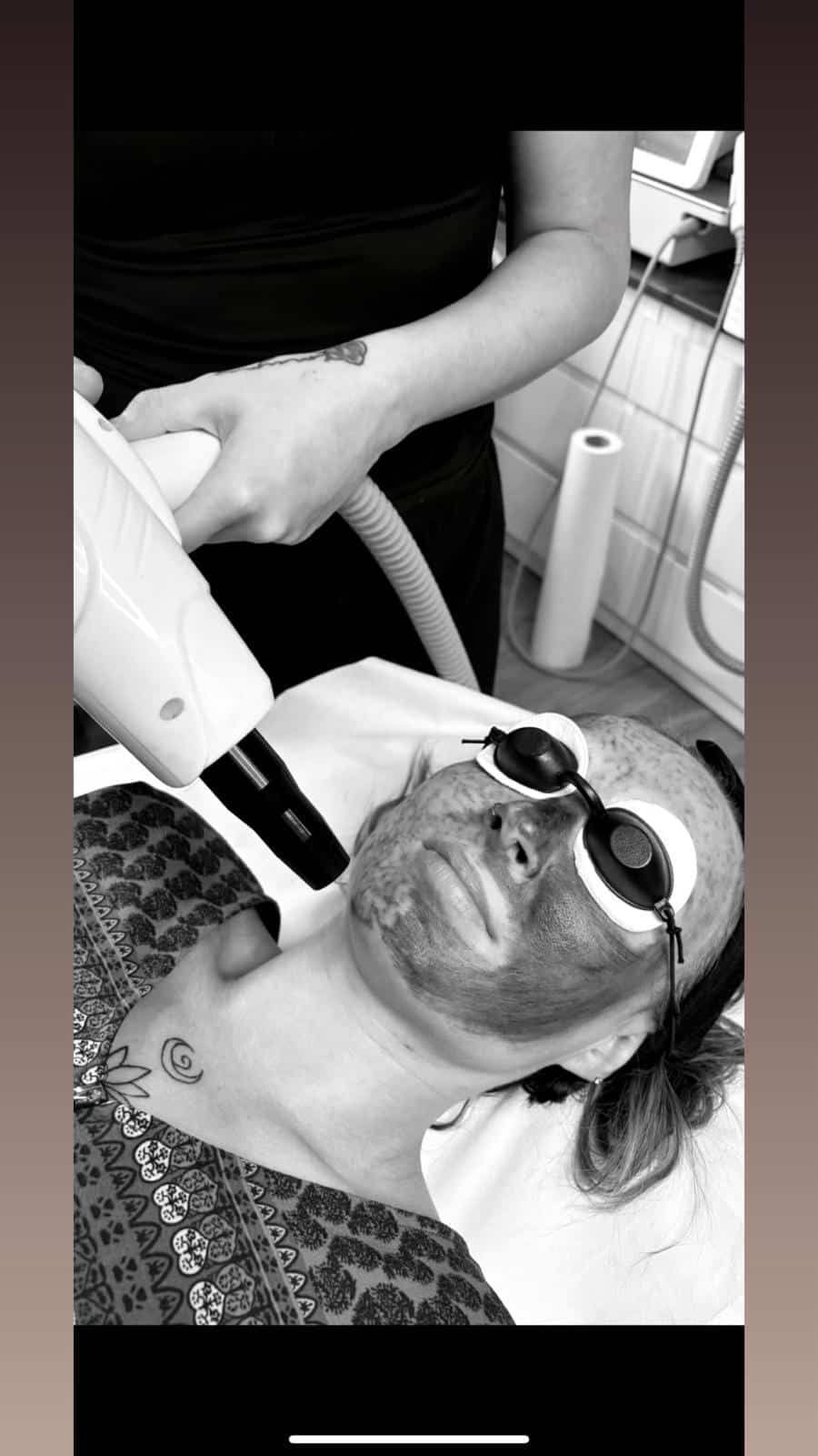 A practitioner uses a laser device to perform a carbon peel facial treatment on a person wearing protective eyewear.