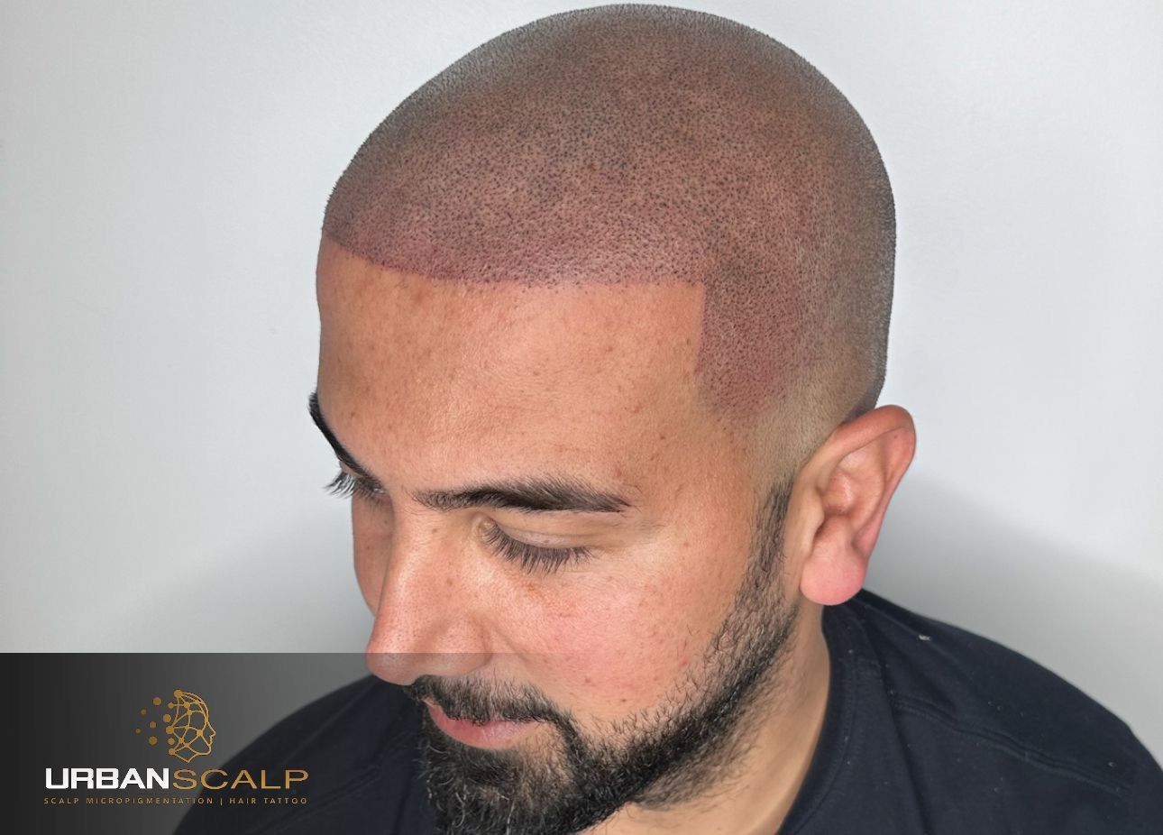 Close-up of a man's head showing a fresh scalp micropigmentation treatment with a defined hairline.