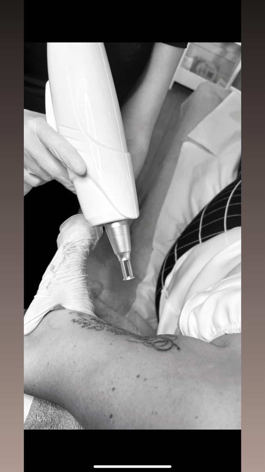 A person holds a handheld laser device over an arm with a tattoo, likely undergoing a laser tattoo removal procedure.