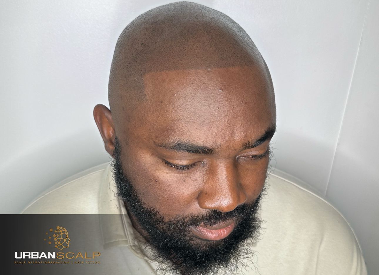 A man with a groomed beard and a precise, tattooed scalp micropigmentation hairline shown from a high angle.