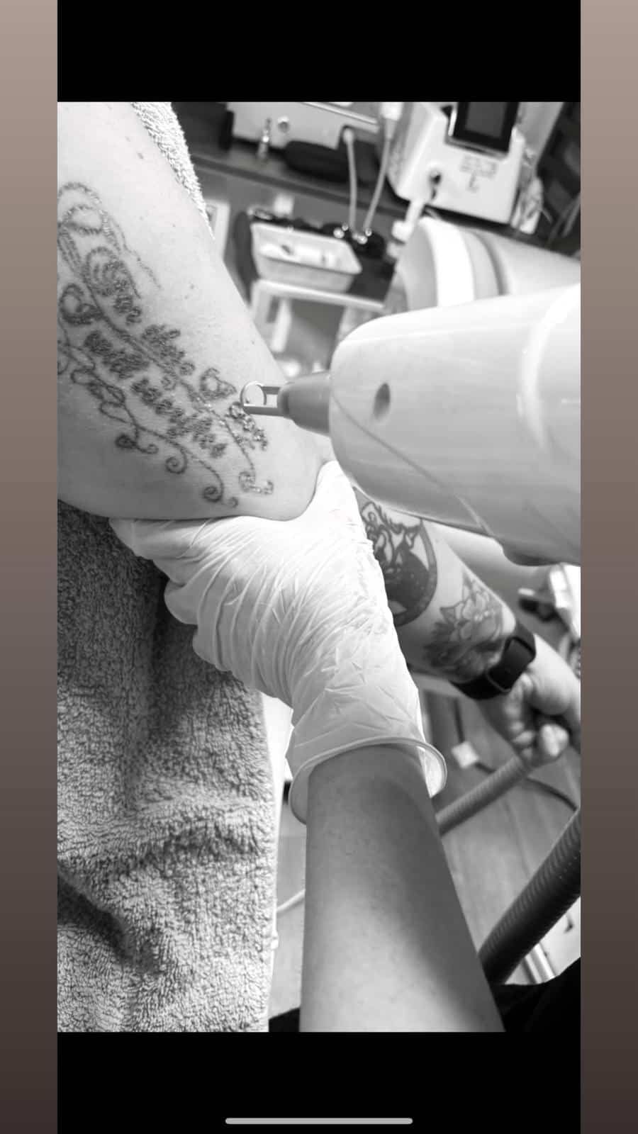 A practitioner wearing a glove uses a laser device on a client’s arm to perform a tattoo removal procedure.