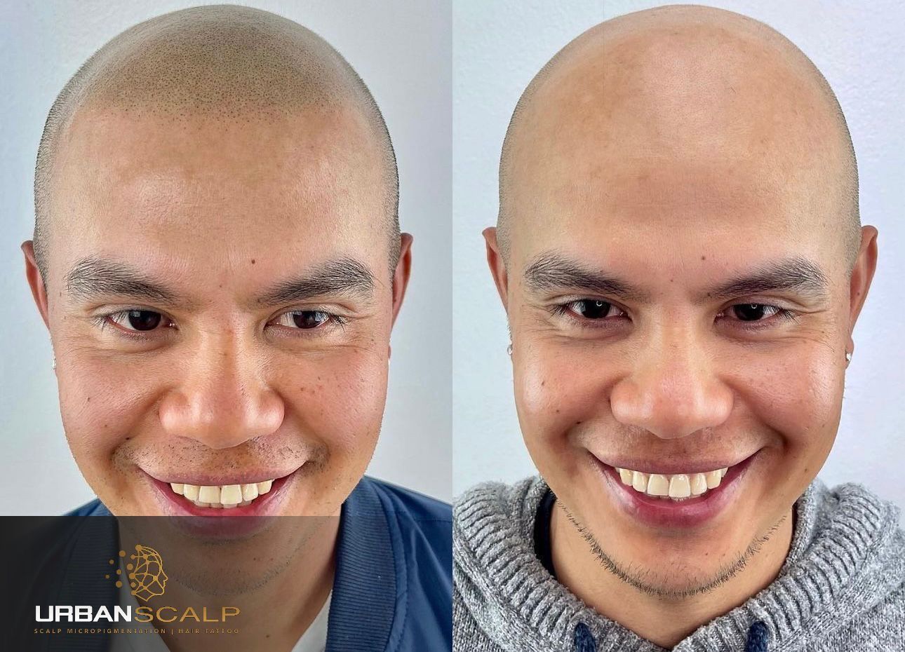 Before-and-after comparison of a person showing scalp micropigmentation, resulting in a fuller, shadowed hairline.
