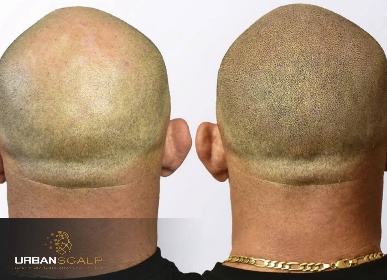 Before and after comparison of scalp micropigmentation showing a fuller, denser look on the right.