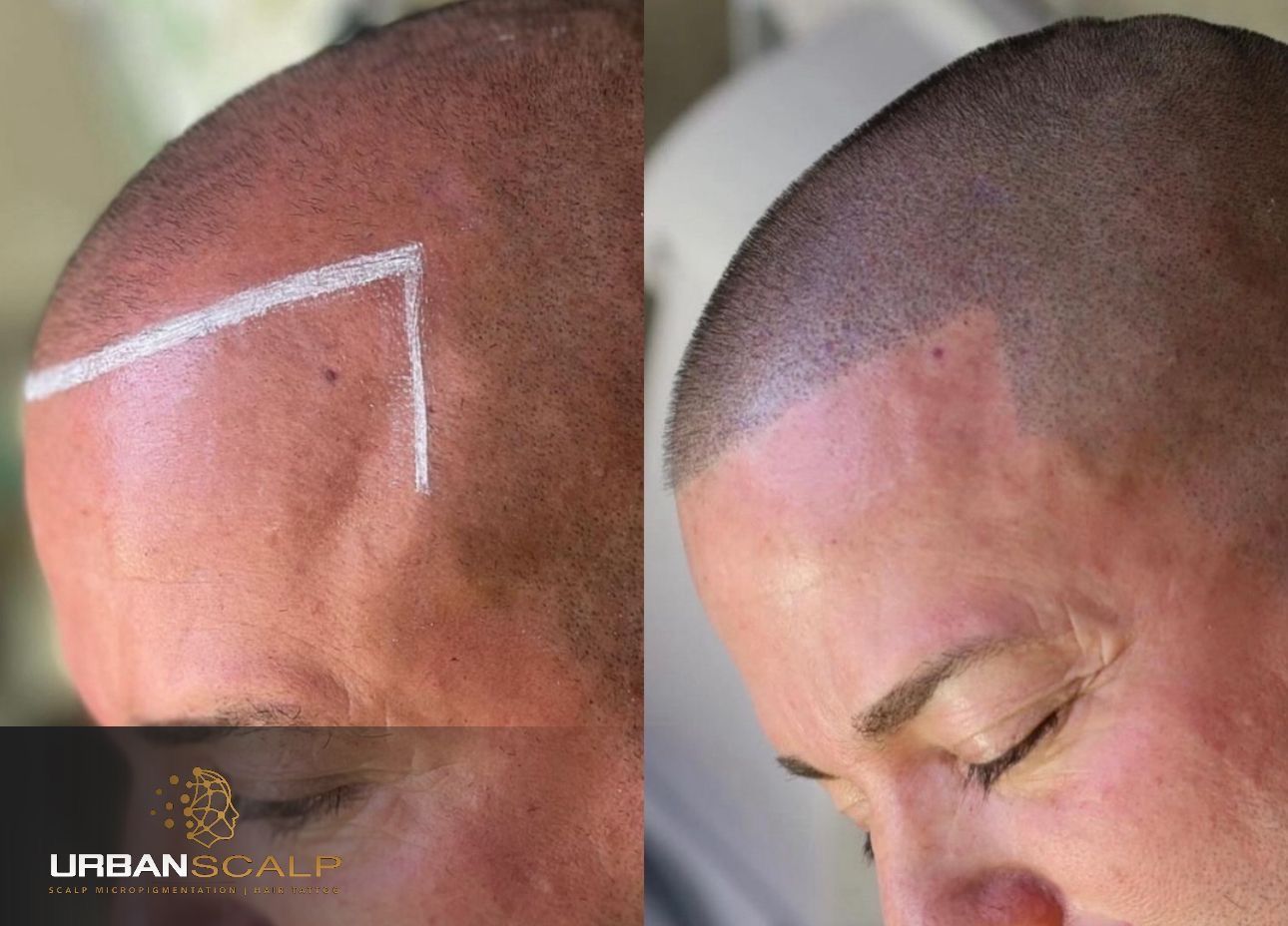 Before and after comparison of a scalp micropigmentation procedure, showing a marked hairline and the finished results.
