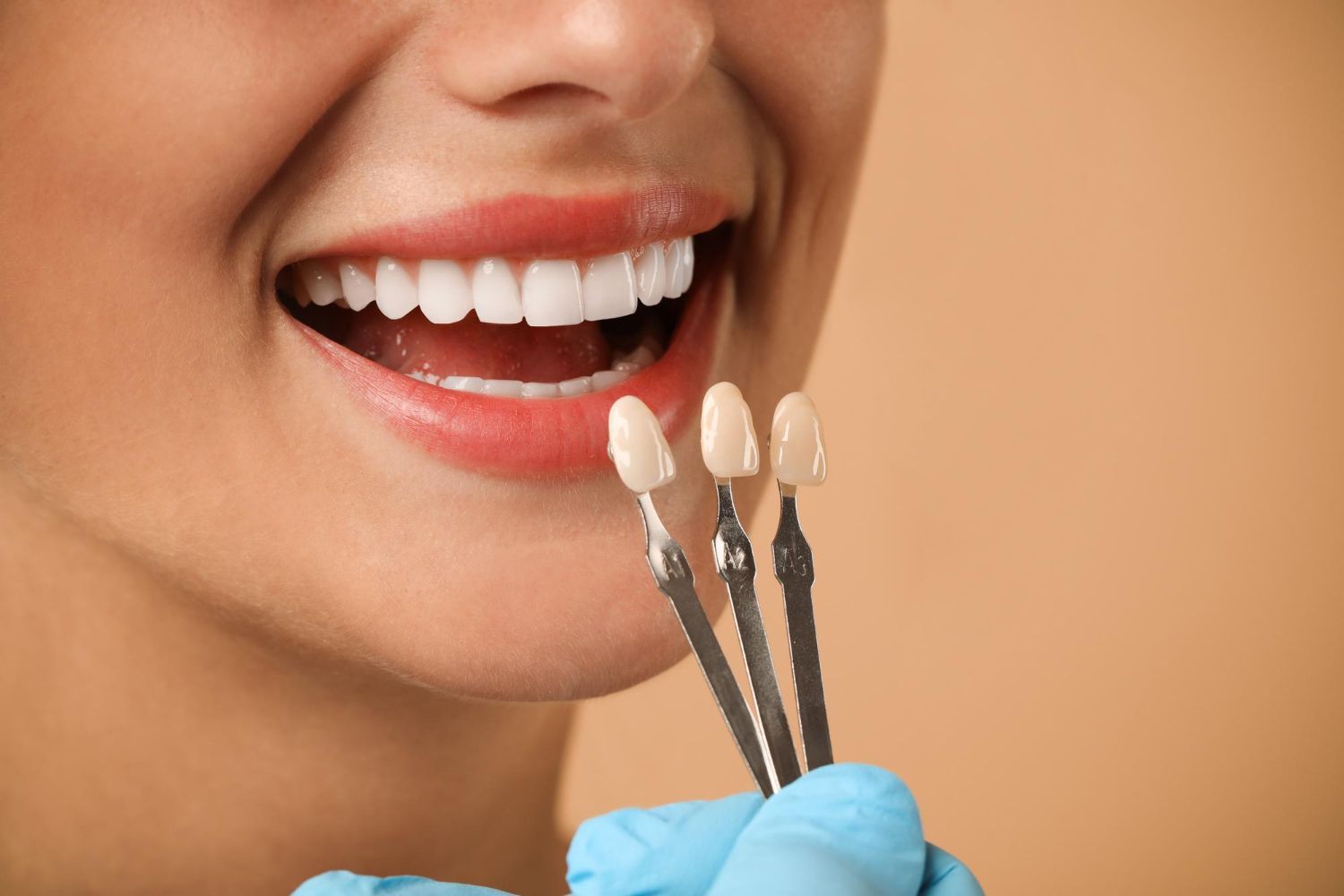 Smile Makeover