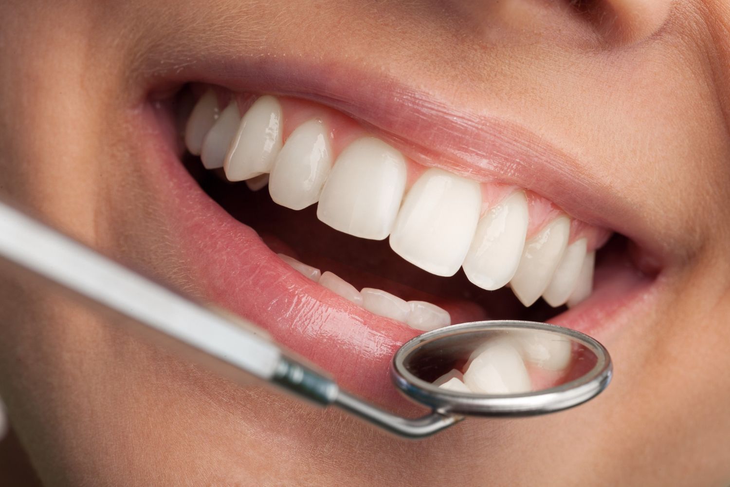 teeth whitening