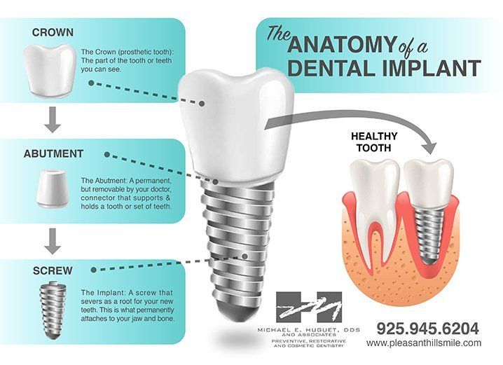 dental implants