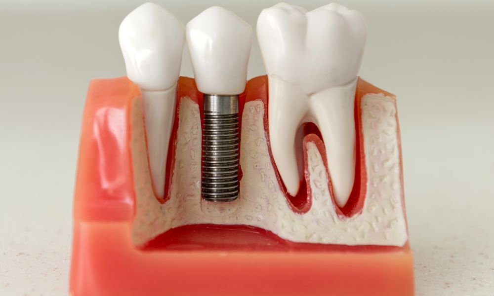 Invisalign treatment