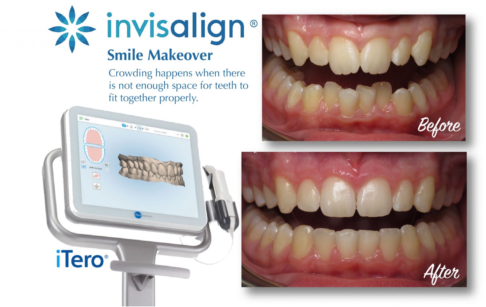 invisalign