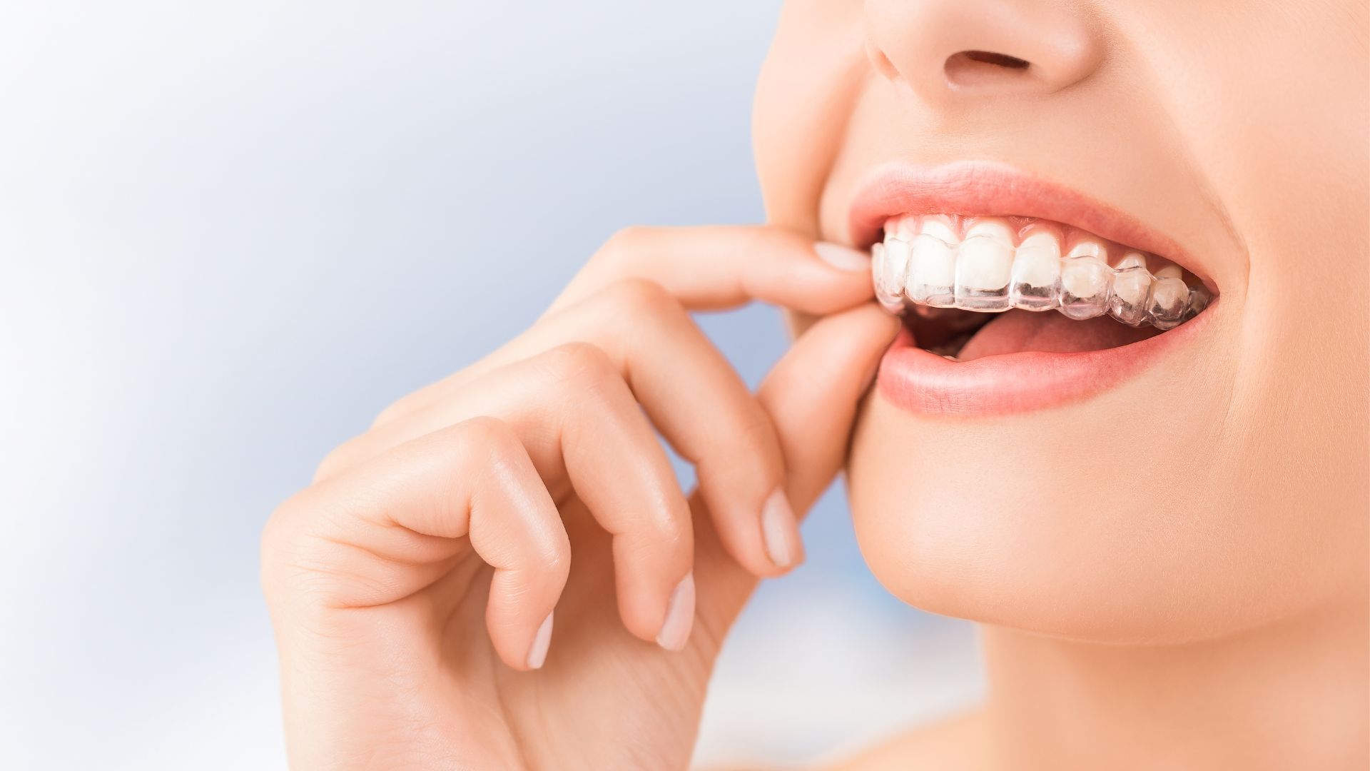 Invisalign treatment