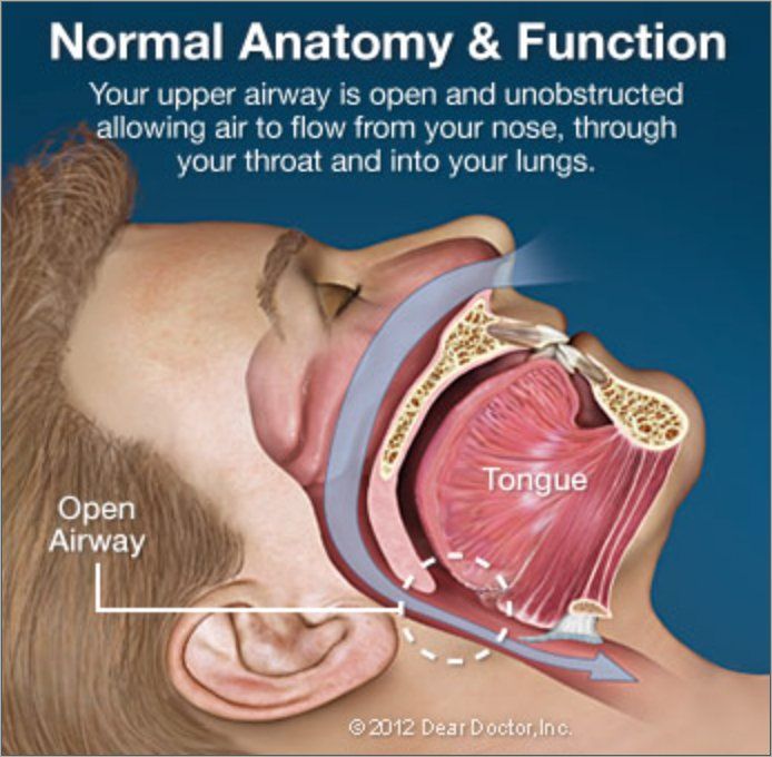 sleep apnea