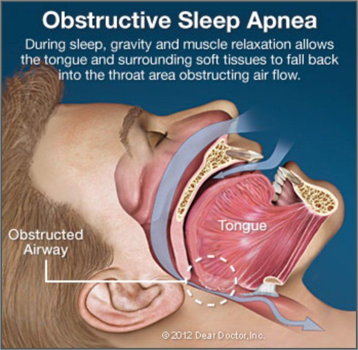 sleep apnea