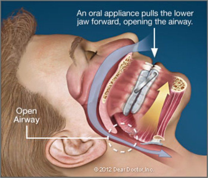 oral appliance