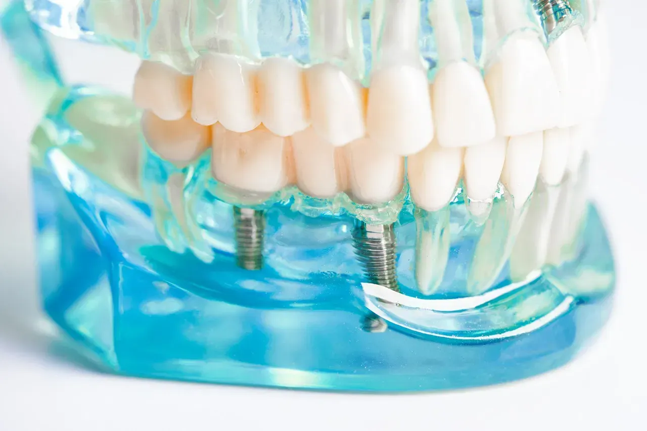 dental implants