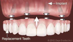 dental implants