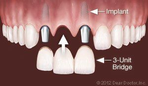 dental implants