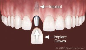 dental implants