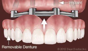 dentures