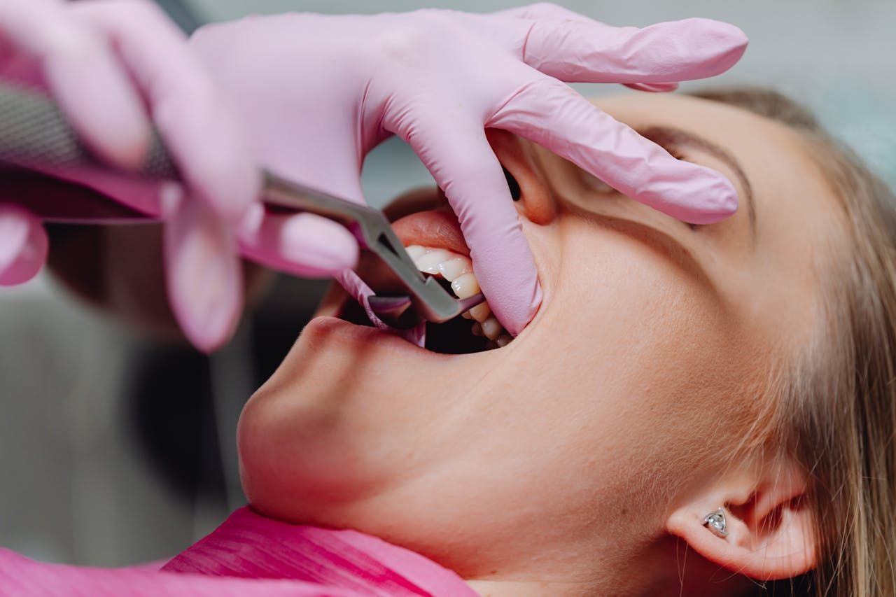 Tooth Removal