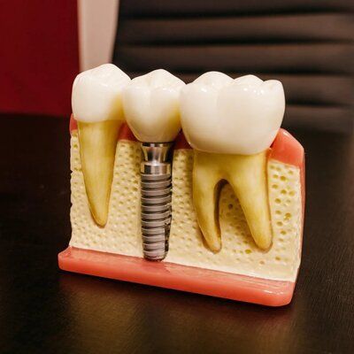 A dental implant model is shown