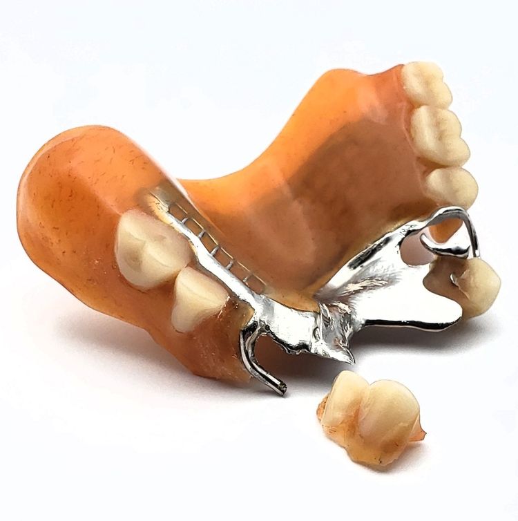 damaged upper partial metal denture