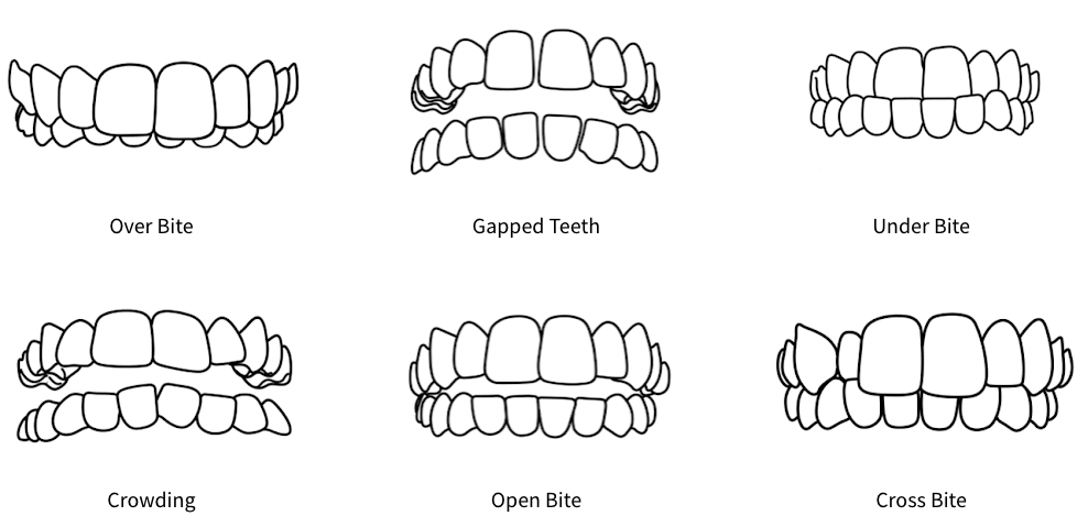 Diagram showing various dental conditions, including overbite, gapped teeth, underbite, crowding, open bite, and crossbite.