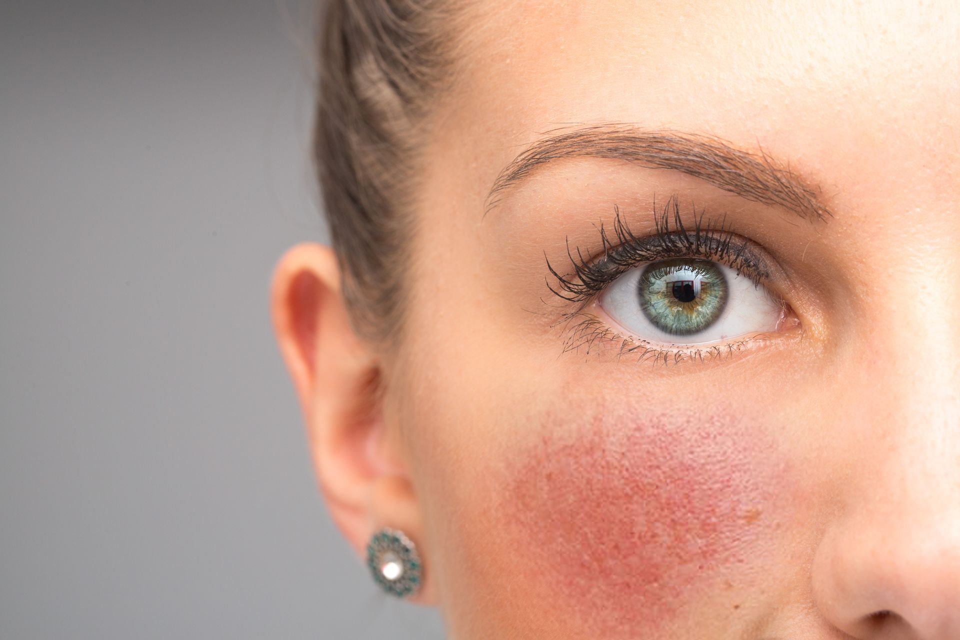 Close-up of a person with a flushed red cheek next to a visible green eye.