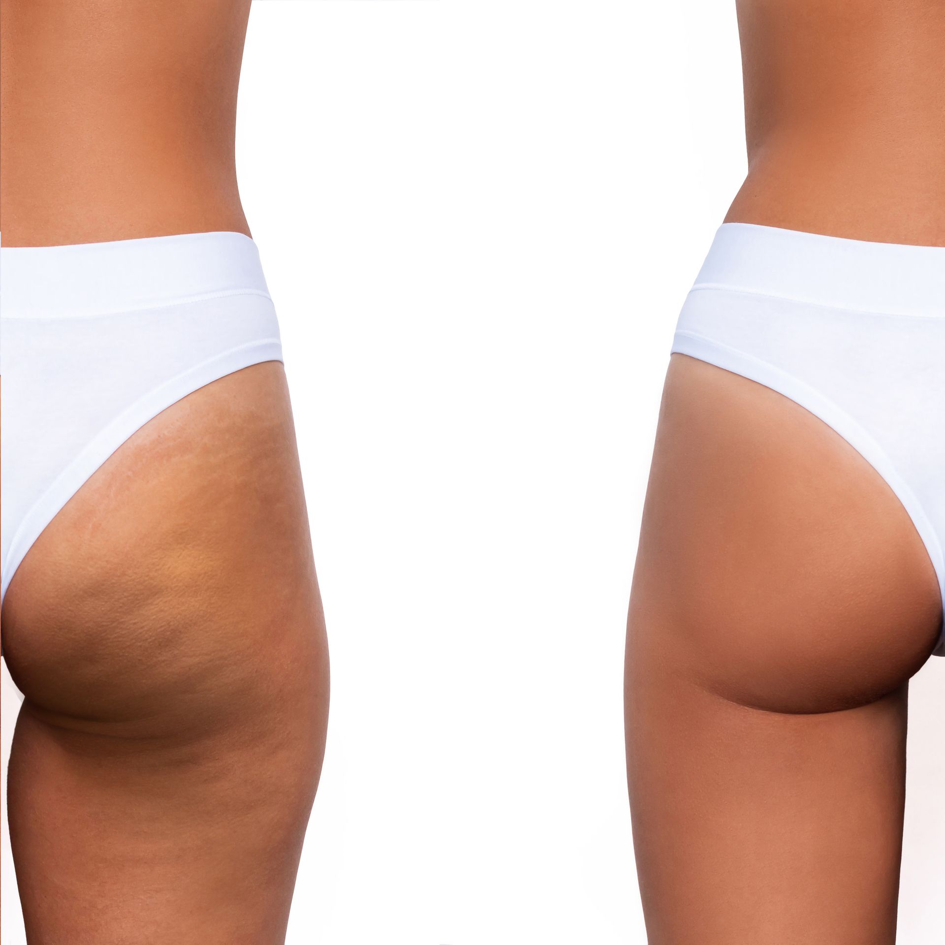 Side-by-side comparison of a person's buttocks. The left side shows cellulite, the right side a smooth appearance.