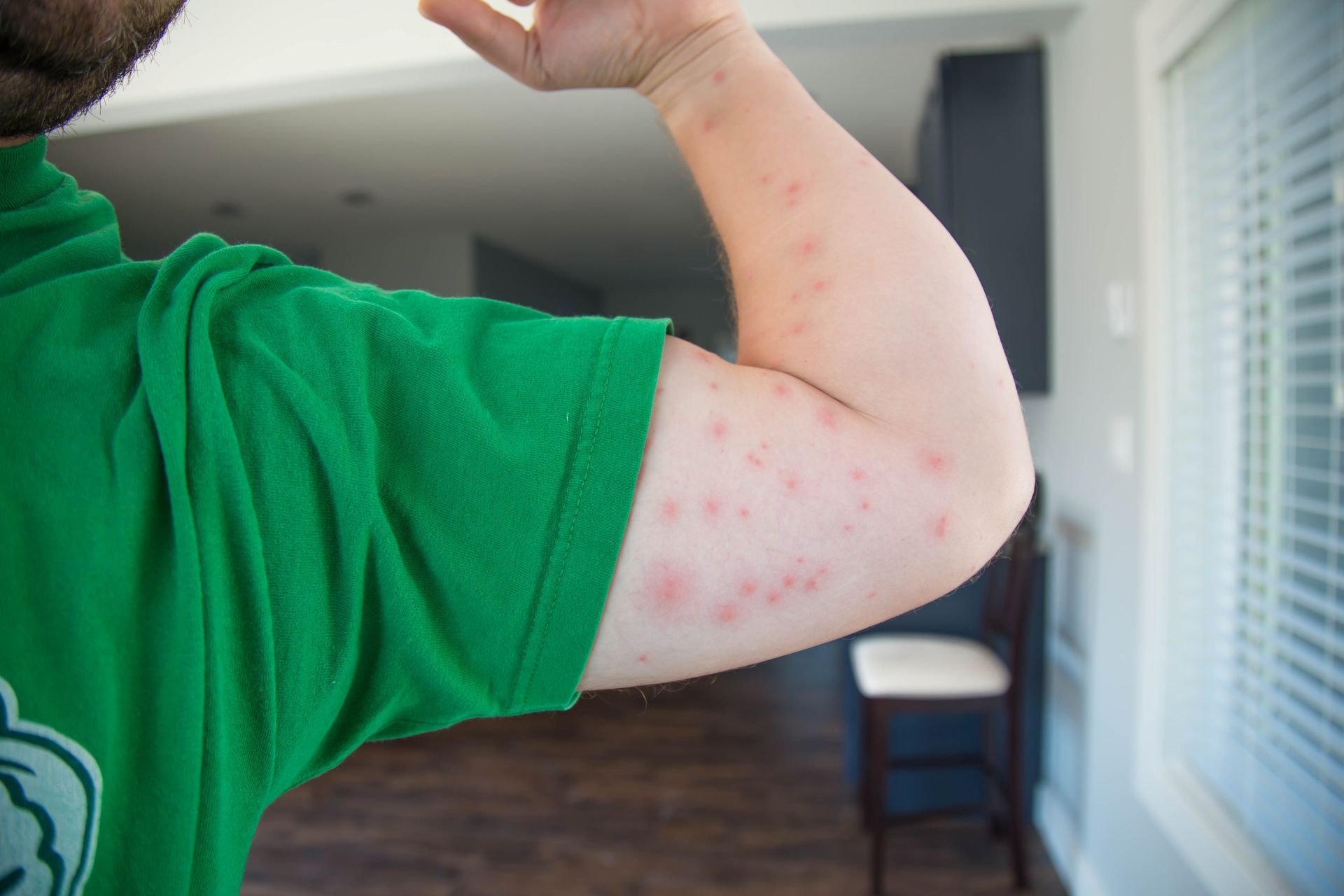Flea bites on skin