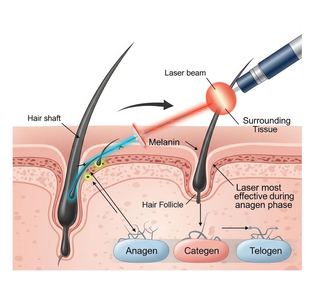 infographic showing how laser hair removal works