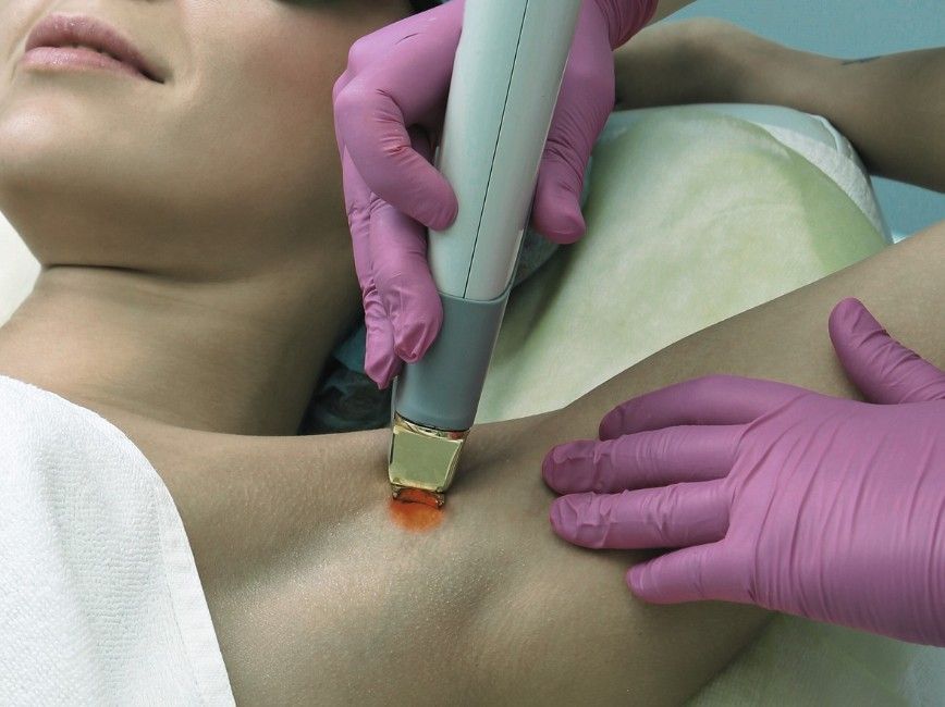 Laser Hair Removal Coventry black skinned woman having laser hair removal performed in under arm area at our Coventry clinic