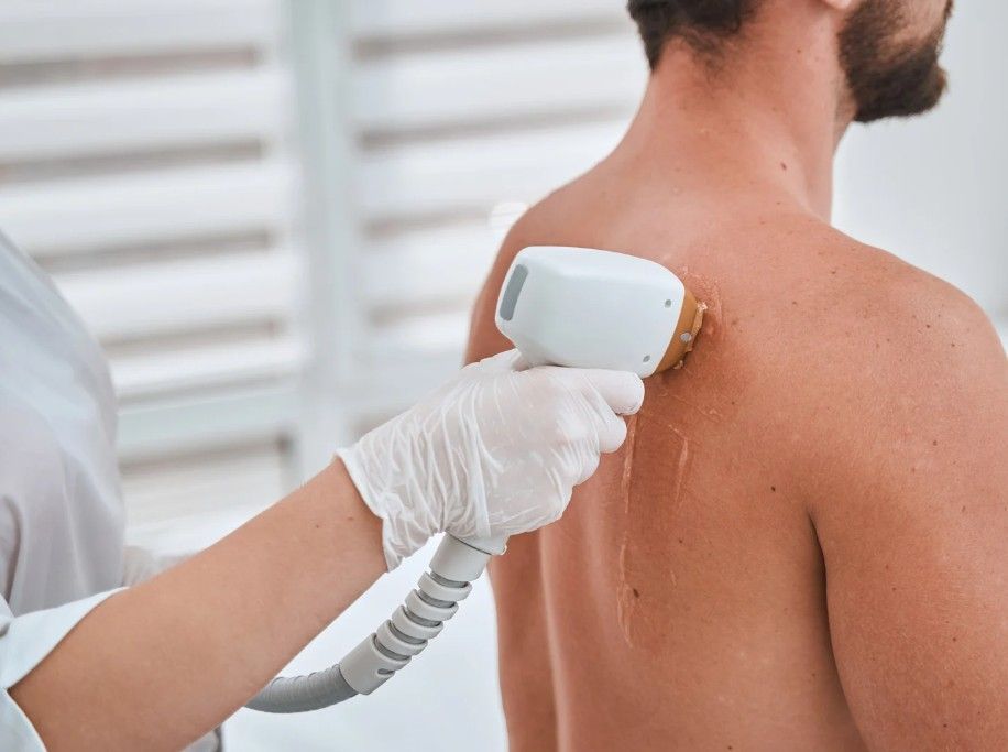 Laser Hair Removal Coventry removing hair form a man's back in Coventry Clinic