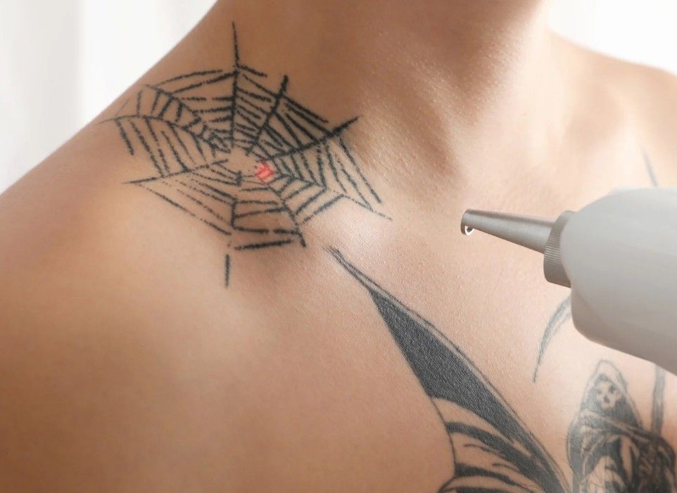 Laser tattoo removal for a client from Ball Hill
