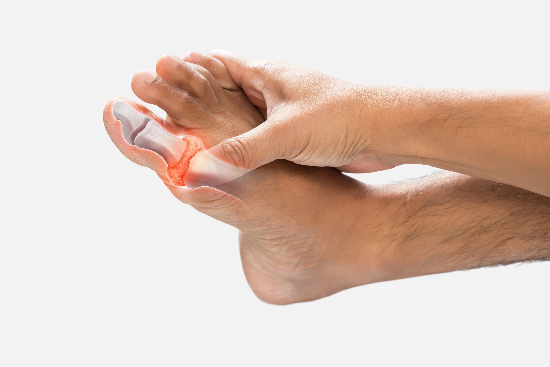 A person is holding their foot in pain because of a broken toe.