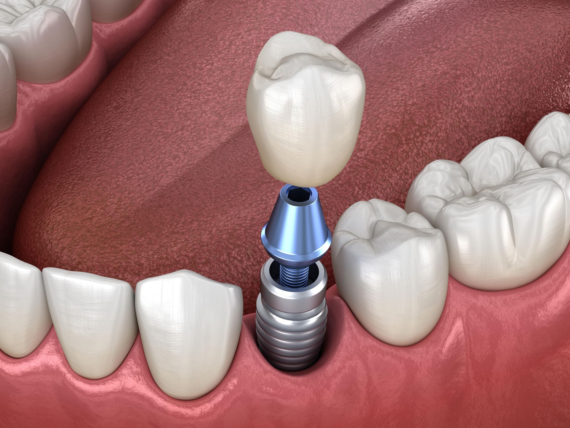 Dental Implants