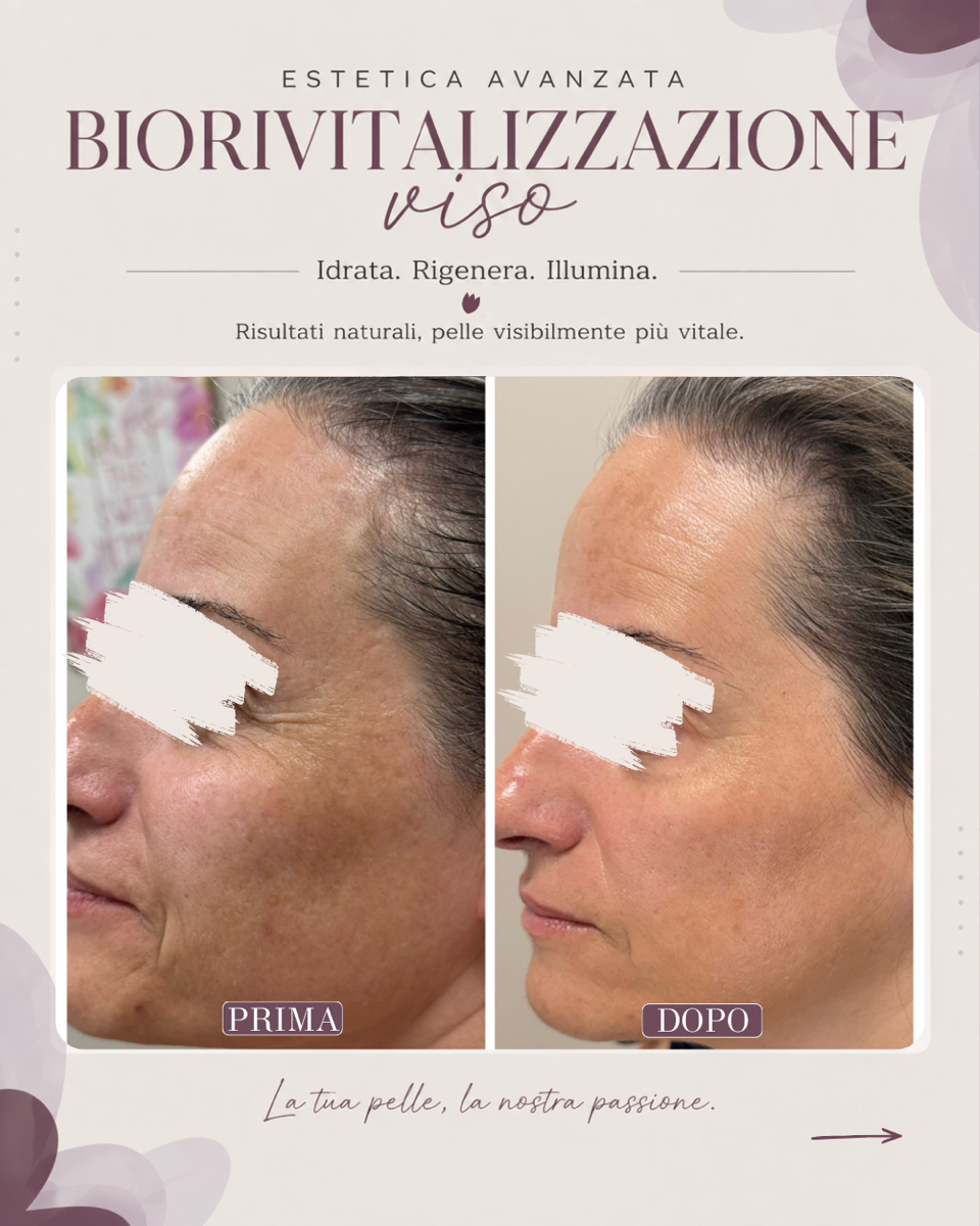 Collage di foto prima e dopo un trattamento per la pelle del viso, che mostra la zona del contorno occhi di una donna con una pelle più liscia dopo il trattamento.