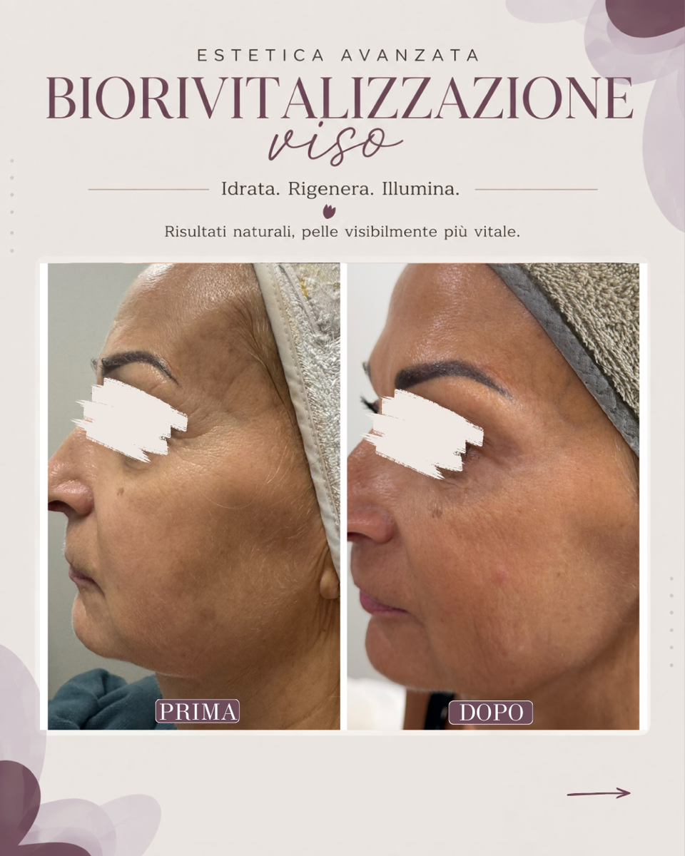 Foto del profilo del viso prima e dopo che mostrano il miglioramento della texture cutanea in seguito al trattamento di biorivitalizzazione.