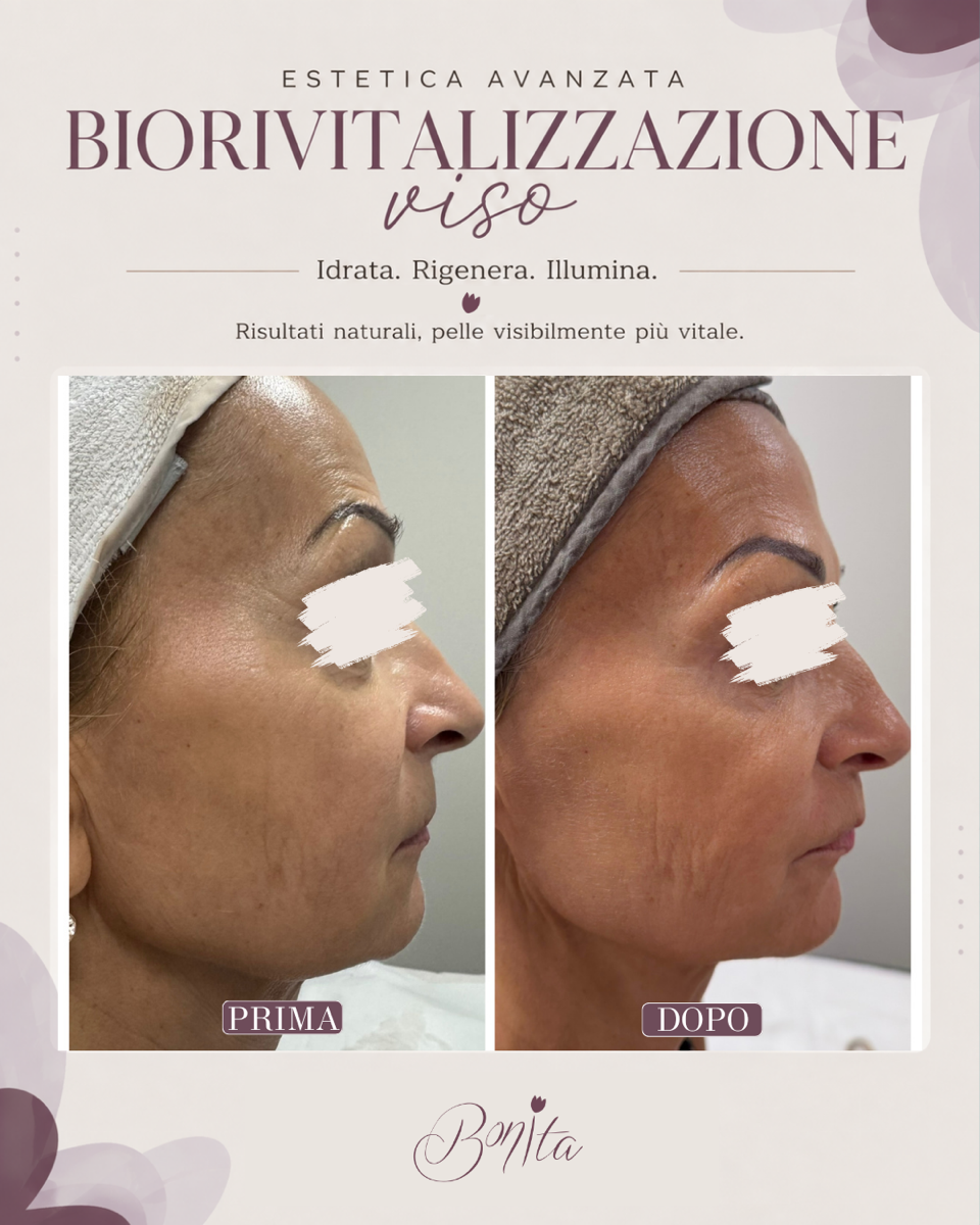Foto affiancate del profilo di un viso prima e dopo un trattamento cosmetico per la pelle, etichettate prima e dopo.
