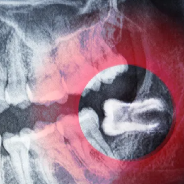 An x-ray of a person 's teeth with wisdom tooth growing in sideways