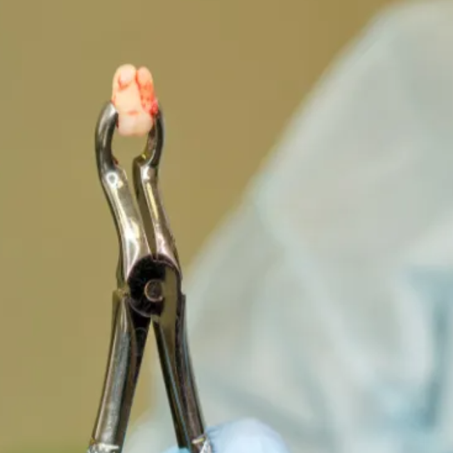 Wisdom Teeth Extraction in Michigan City, Indiana
