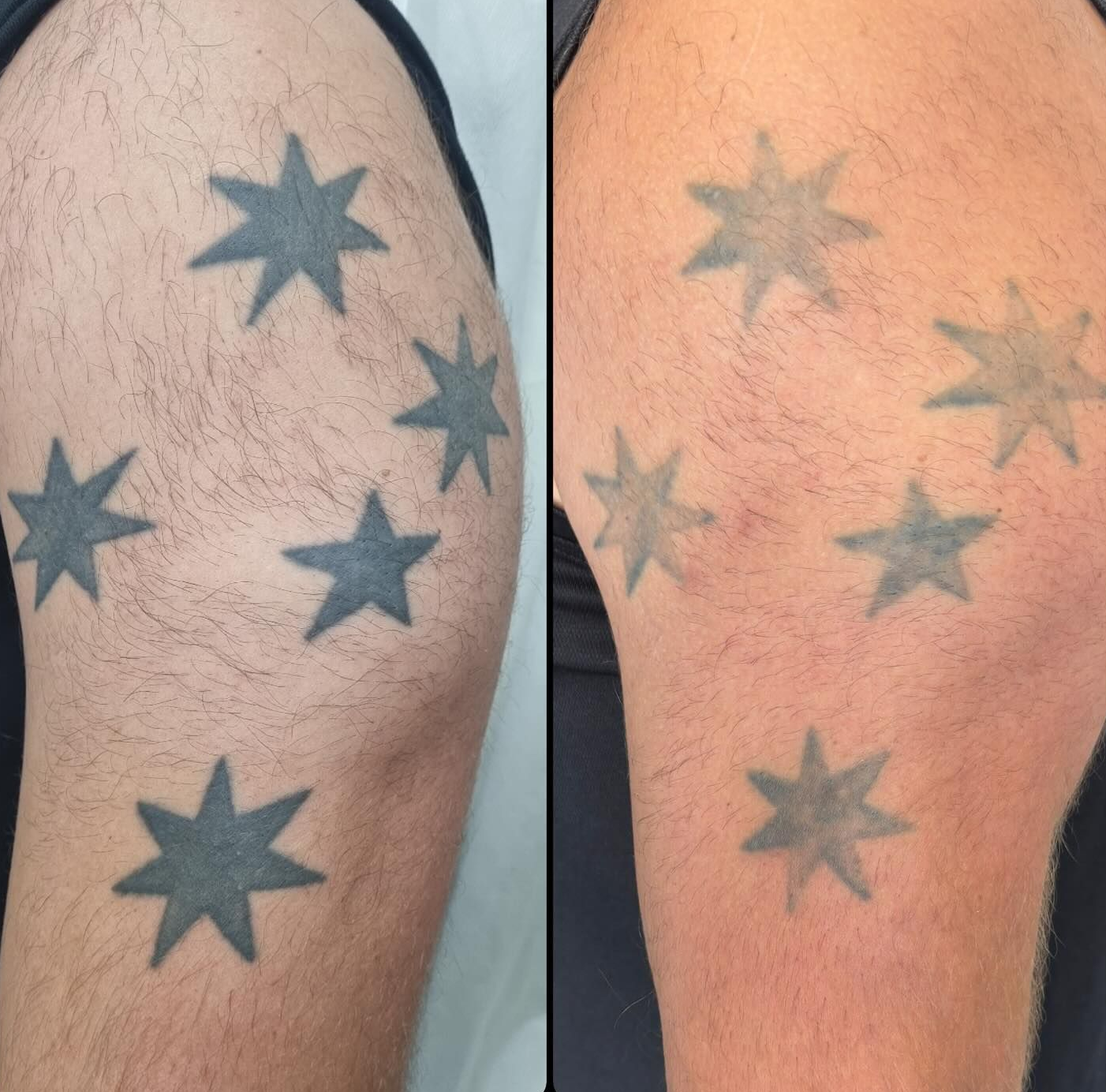 Side-by-side Close-up of a Tattooed Upper Arm — Laserpro Tattoo Removal in Kiama, NSW