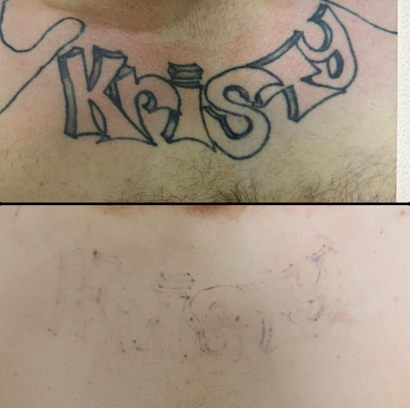 Black-outlined Graffiti-style Tattoo — Laserpro Tattoo Removal in Kiama, NSW