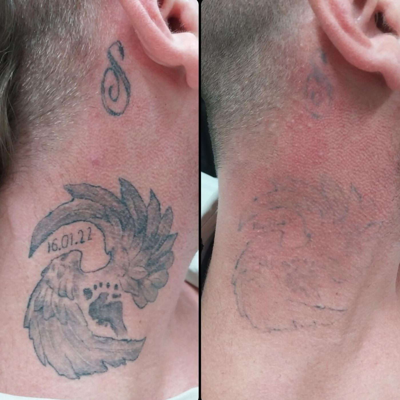 Before-and-after of a Neck Tattoo — Laserpro Tattoo Removal in Kiama, NSW
