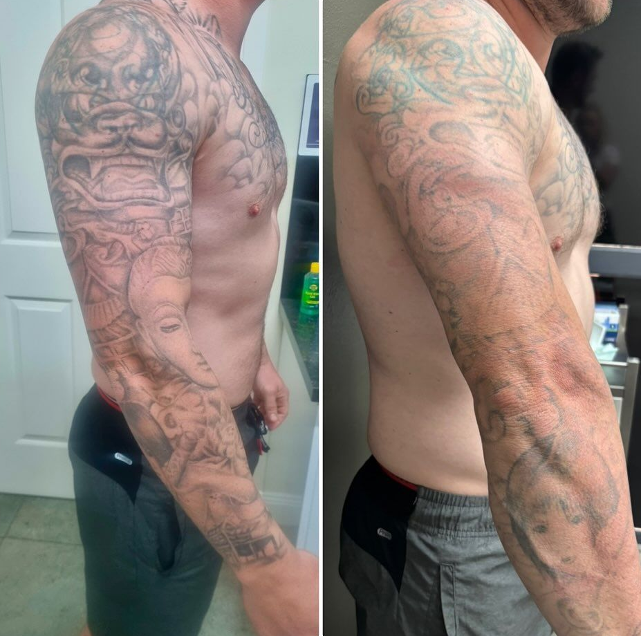 Side-by-side Photos of a Tattooed Man's Torso and Arm — Laserpro Tattoo Removal in Illawarra, NSW