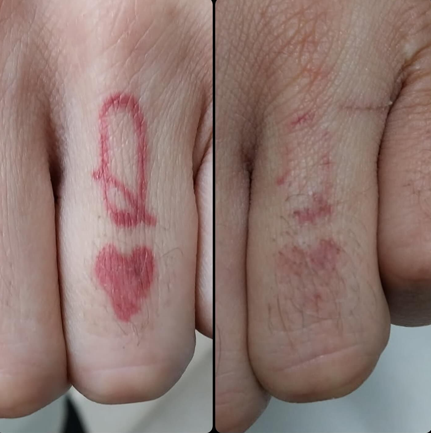 Close-up of Two Fists With Tattoo — Laserpro Tattoo Removal in Illawarra, NSW