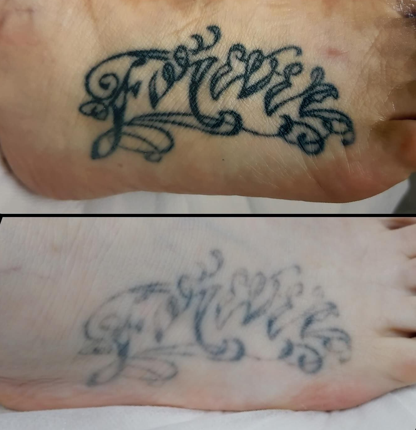 Dark Tattoo on Skin — Laserpro Tattoo Removal in Wollongong, NSW
